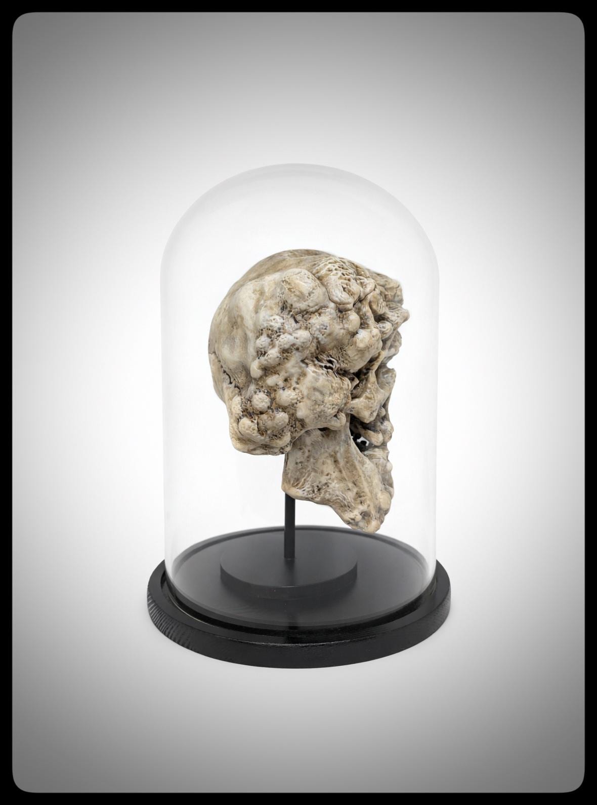Joseph Merrick Skull 3D Resin Sculpture – 3D Sculpt by Carlito Brigante