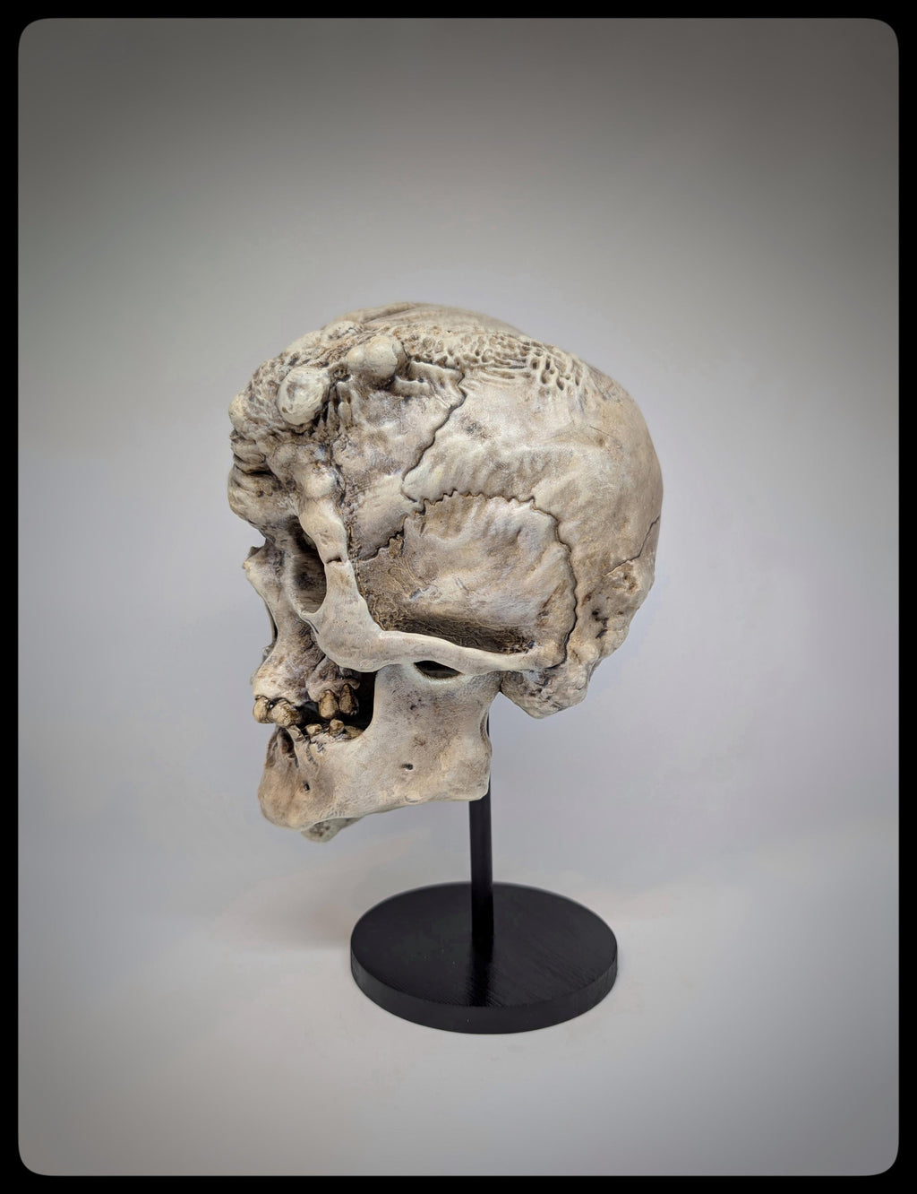 Joseph Merrick Skull 3D Resin Sculpture – 3D Sculpt by Carlito Brigante