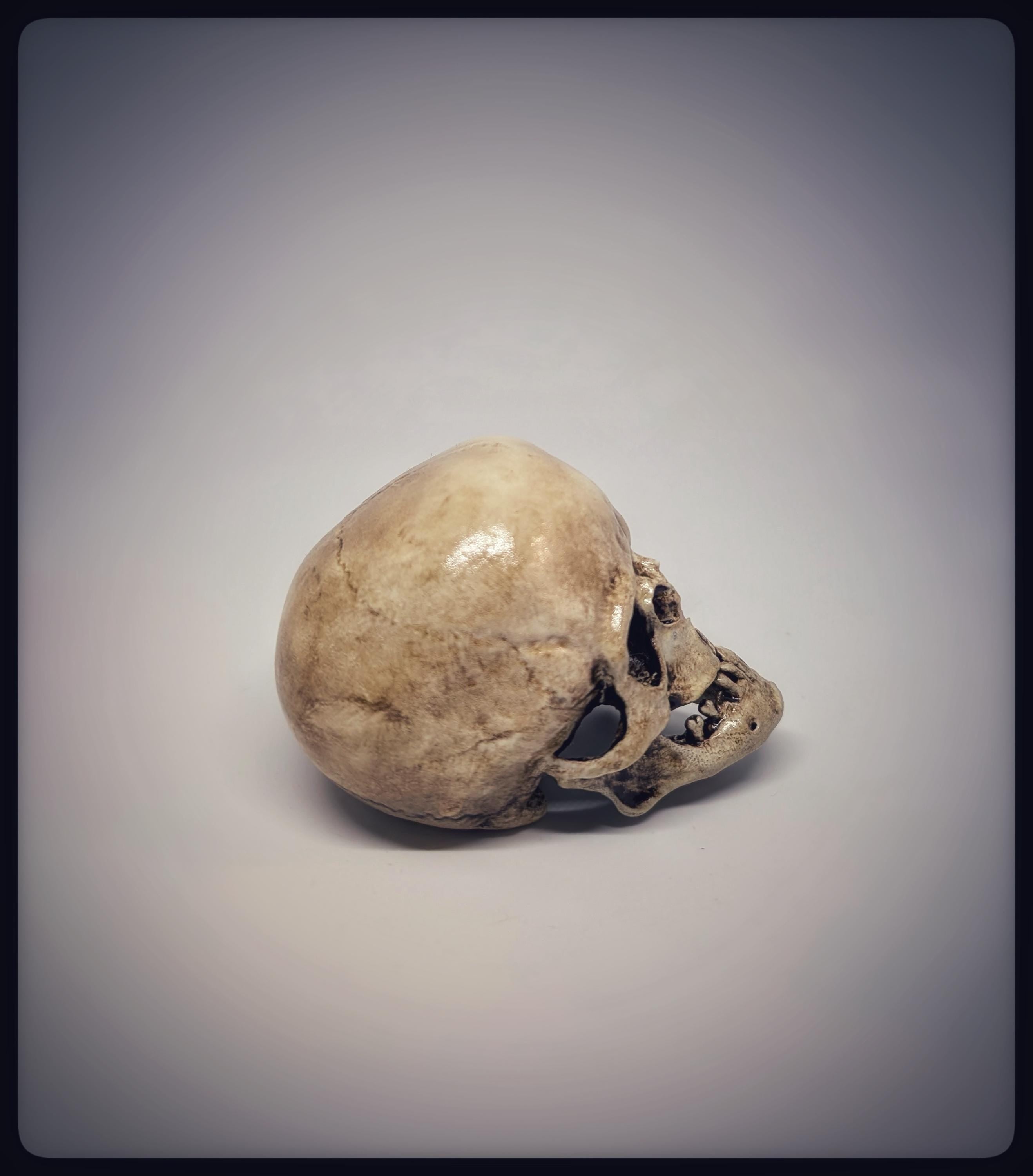 Craniosynostosis Skull 3D Resin Model 2.76x2.95in (7x7.5 cm) Anatomical